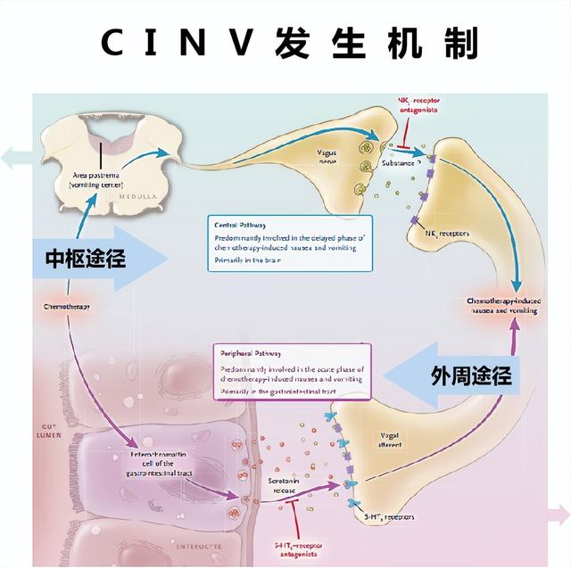 化疗相关性呕吐（CINV）的防治指南