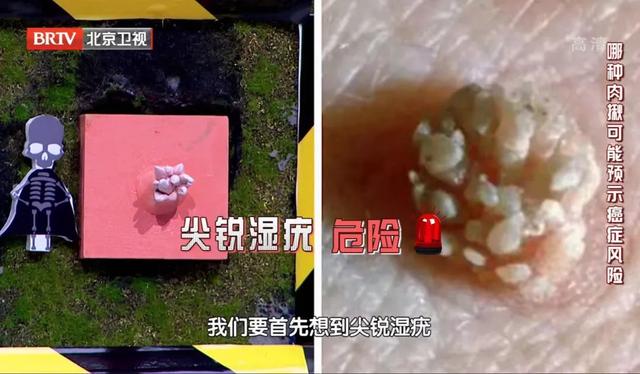 身上这种“小疙瘩”千万别乱抠，可能传染、致癌！4大常见皮肤问题，专家一次说清